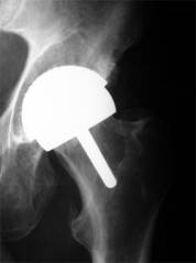 birmingham hip replacement